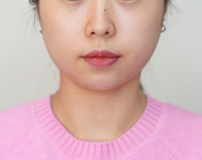 이중턱 지방분해주사, U라인이 V라인으로 바뀌는 단계와 3가지 타입 사진 7