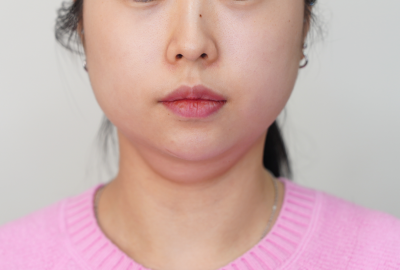 이중턱 지방분해주사, U라인이 V라인으로 바뀌는 단계와 3가지 타입 사진 6