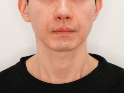 쥬베룩 볼륨 유지기간의 오해와 진실 '힐로베룩'이 다른 이유 총정리 사진 8