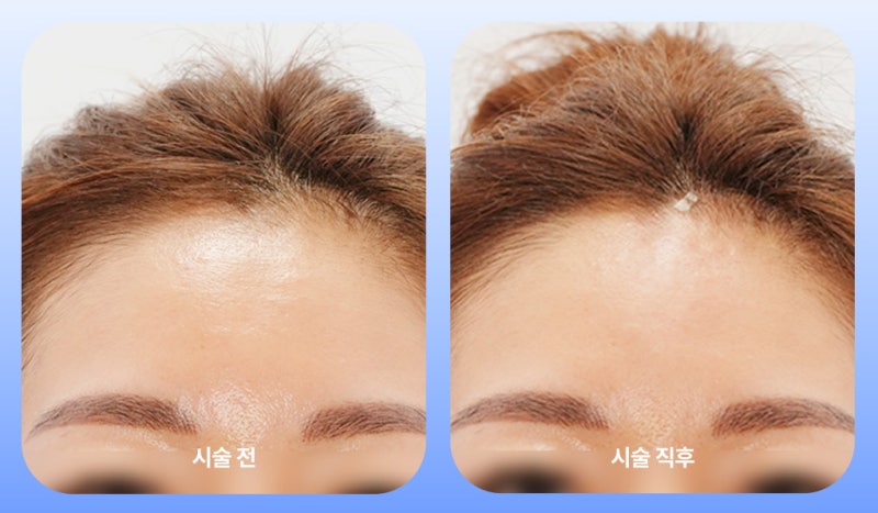 쥬베룩 볼륨 유지기간의 오해와 진실 '힐로베룩'이 다른 이유 총정리 사진 11