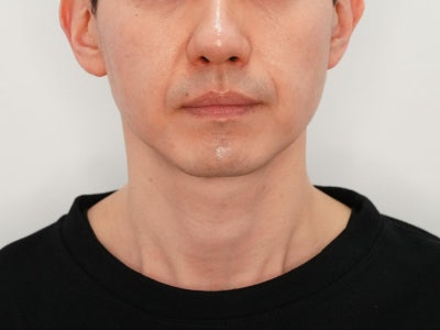쥬베룩 볼륨 유지기간의 오해와 진실 '힐로베룩'이 다른 이유 총정리 사진 7