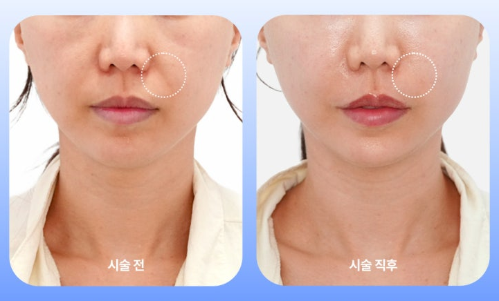 쥬베룩 볼륨 유지기간의 오해와 진실 '힐로베룩'이 다른 이유 총정리 사진 12