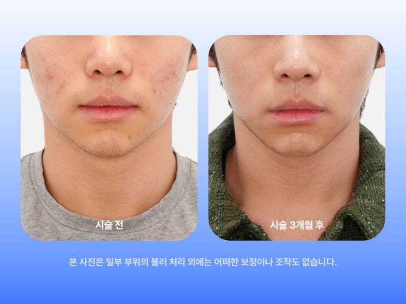여드름 흉터 피부과, 후회 없이 선택하려면 확인해야 할 3가지 사진 6