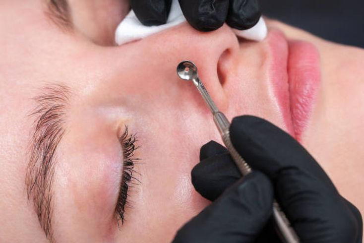 코 모공 레이저, 블랙헤드까지 잡으려면? 포텐자로 설계하는 3단계 사진 3
