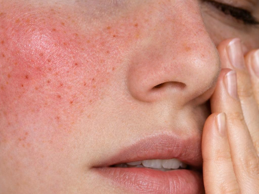 코 모공 레이저, 블랙헤드까지 잡으려면? 포텐자로 설계하는 3단계 사진 10