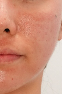 코 모공 레이저, 블랙헤드까지 잡으려면? 포텐자로 설계하는 3단계 사진 8