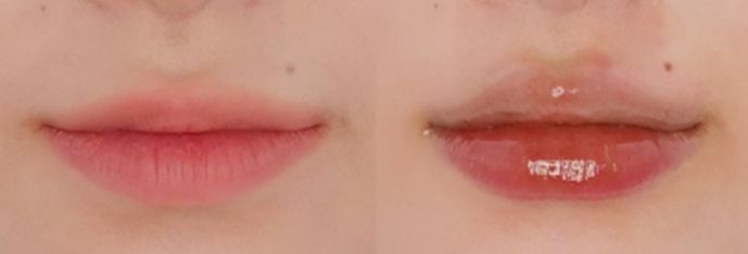 입술필러 국산 vs 수입필러, 가격만 보고 선택하면 안 되는 이유 사진 8