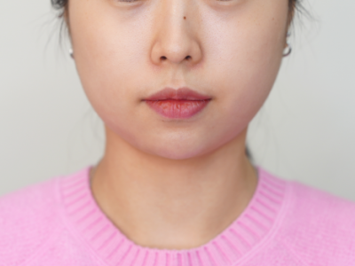 강남 지방분해주사, 병원을 고르기 전 확인해야 할 3가지 기준 사진 10