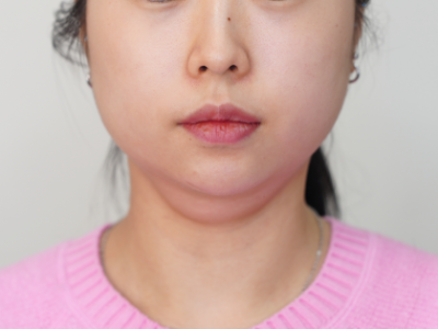강남 지방분해주사, 병원을 고르기 전 확인해야 할 3가지 기준 사진 9