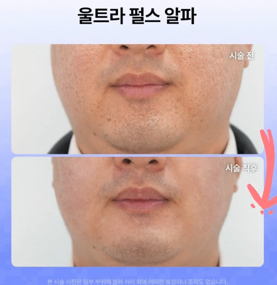 여드름 흉터 프락셀, 몇 번에 얼마나 좋아질까? 유형별 치료 단계 총정리 사진 7