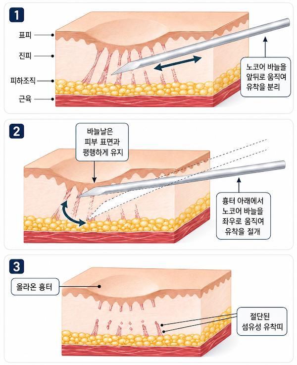 여드름 흉터 프락셀, 몇 번에 얼마나 좋아질까? 유형별 치료 단계 총정리 사진 4