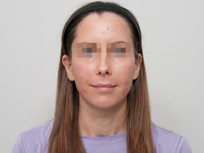 여드름 흉터 프락셀, 몇 번에 얼마나 좋아질까? 유형별 치료 단계 총정리 사진 11