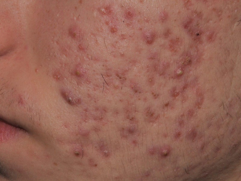 여드름 흉터 프락셀, 몇 번에 얼마나 좋아질까? 유형별 치료 단계 총정리 사진 14