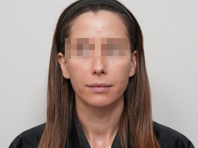 여드름 흉터 프락셀, 몇 번에 얼마나 좋아질까? 유형별 치료 단계 총정리 사진 8