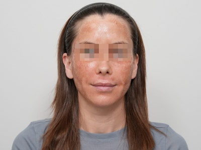 여드름 흉터 프락셀, 몇 번에 얼마나 좋아질까? 유형별 치료 단계 총정리 사진 10