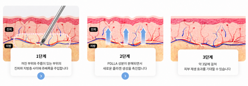 쥬베룩 통증, 마취하면 얼마나 줄어들까요? 시술 단계별 느낌과 통증 줄이는 3가지 방법 사진 7
