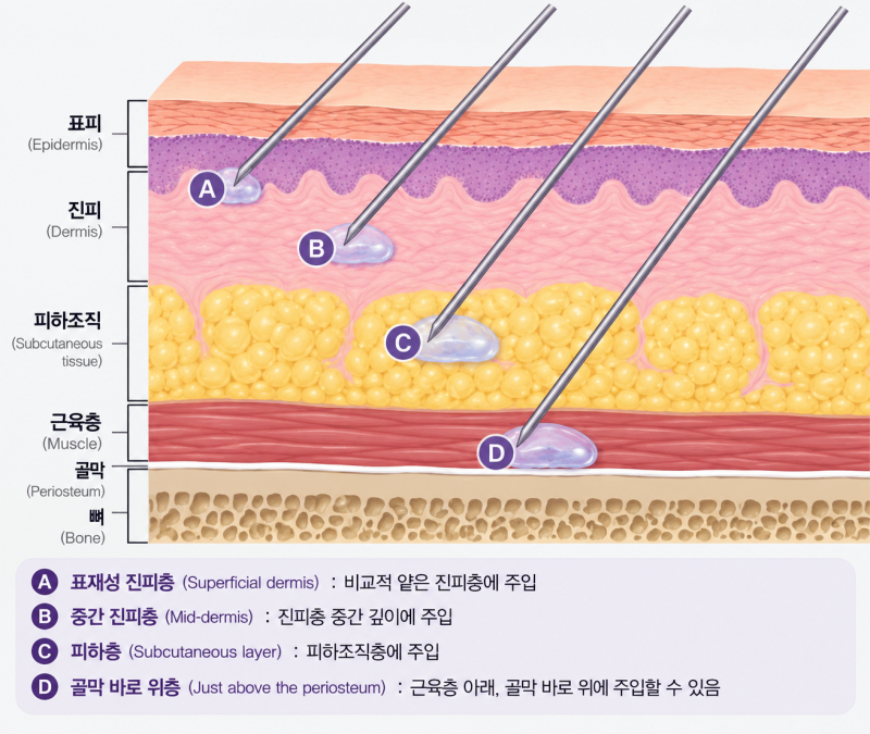 옆볼필러 붓기 다 똑같지 않은 이유, 성형외과 전문의 핵심 노하우 사진 9