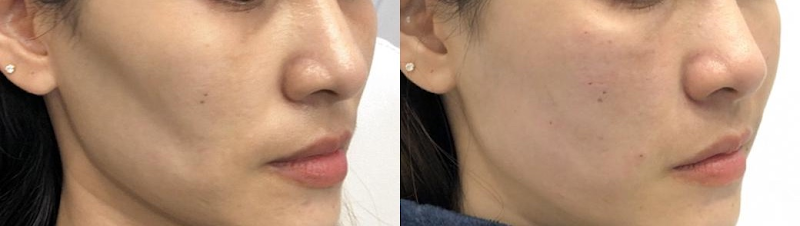 옆볼필러 붓기 다 똑같지 않은 이유, 성형외과 전문의 핵심 노하우 사진 11